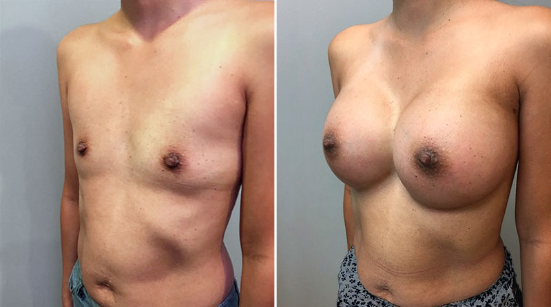 Dr. Alexander & Co. - Breast augmentation done with silicone gel